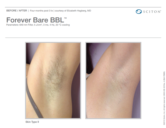 Laser Hair Removal BBL Forever Bare Albany OR Pure Beauty